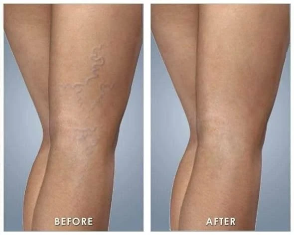 Viên uống chống Giãn Tĩnh Mạch Abtei Venen Aktiv, 60 Viên